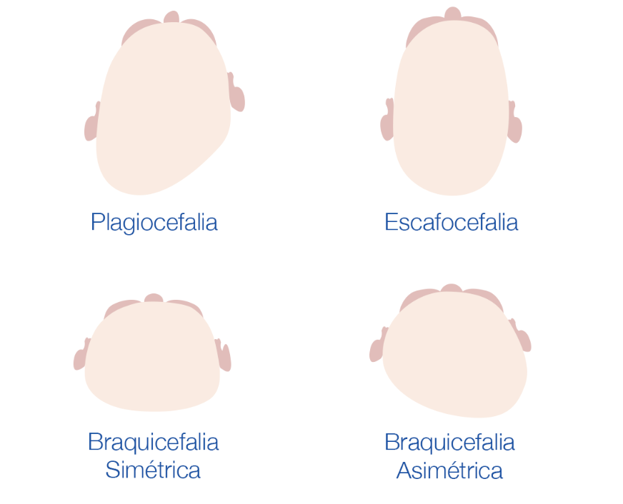 plagiocefalia